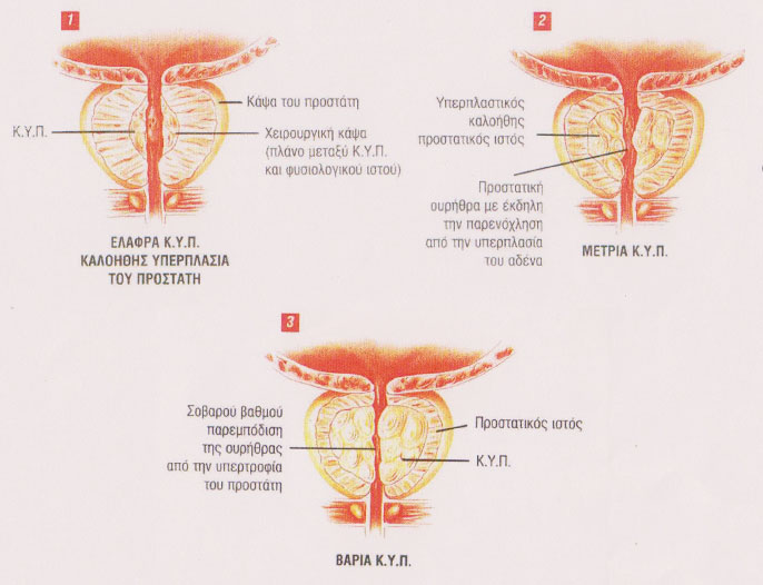 Prostatis