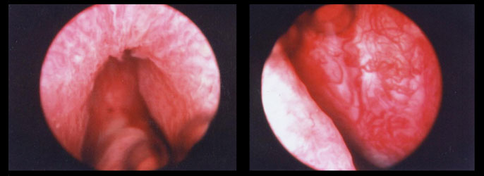 Iperplasia prostati